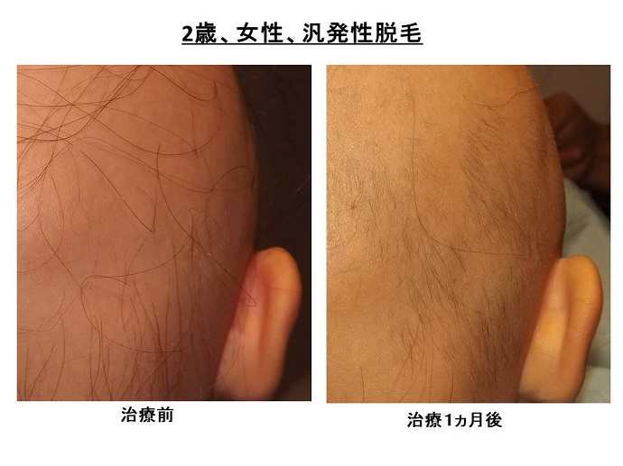 円形脱毛症　病院""